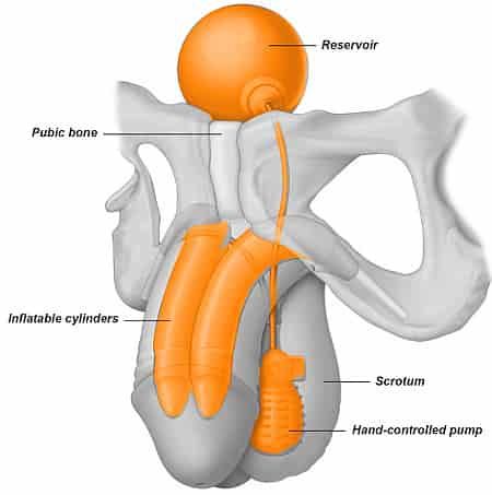 Введение вещества под кожу пениса